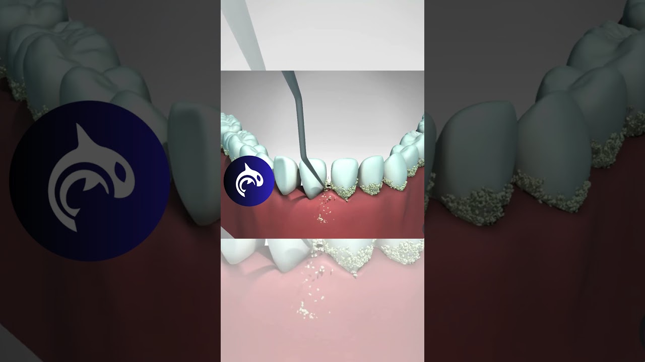 A 3D look at Professional Teeth Cleaning 🦷✨ #asmr